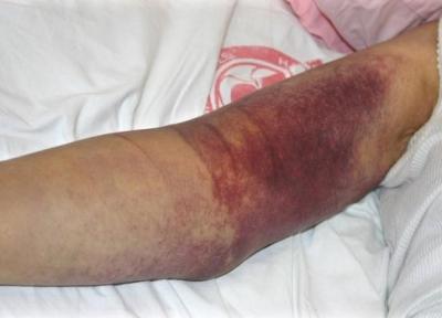 شناسایی 18 بیمار مبتلا به تب کریمه کنگو در ایران ، علائم چیست و چگونه از ابتلا به بیماری پیشگیری کنیم؟